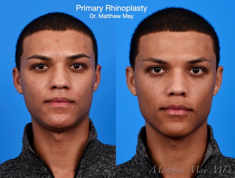 Rhinoplasty Before & After Image