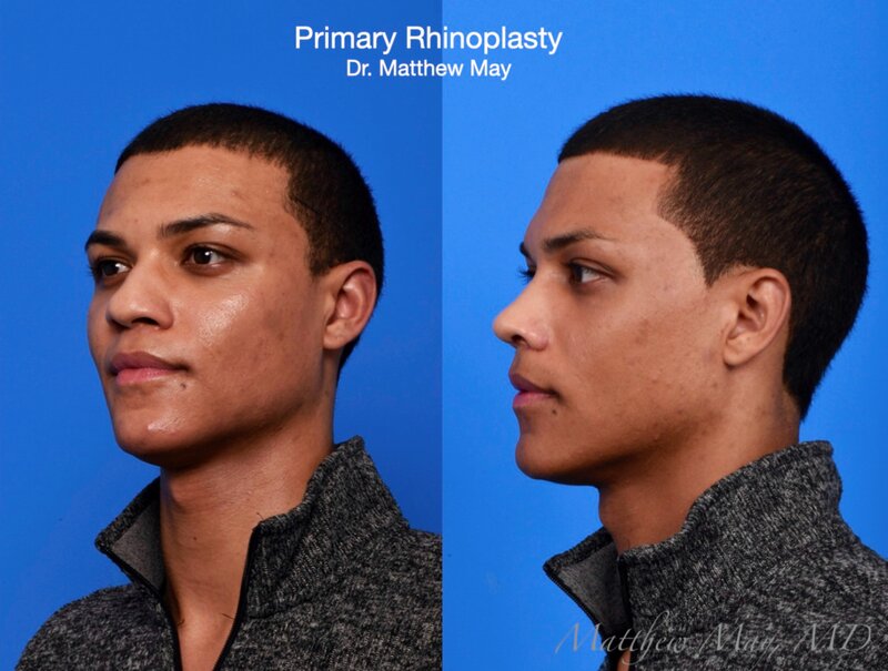 Rhinoplasty Before & After Image