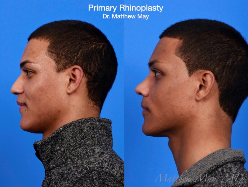 Rhinoplasty Before & After Image