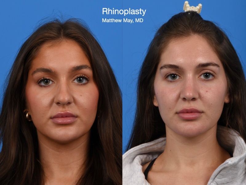 Rhinoplasty Before & After Image