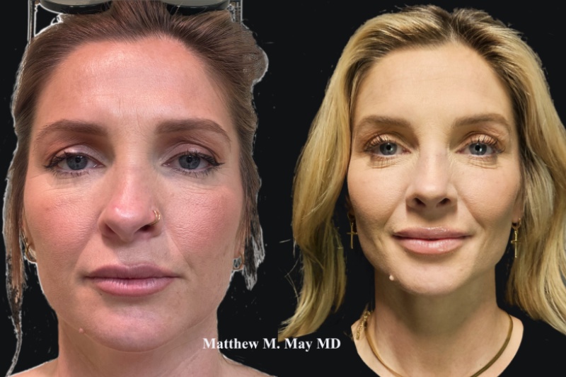 Rhinoplasty Before & After Image