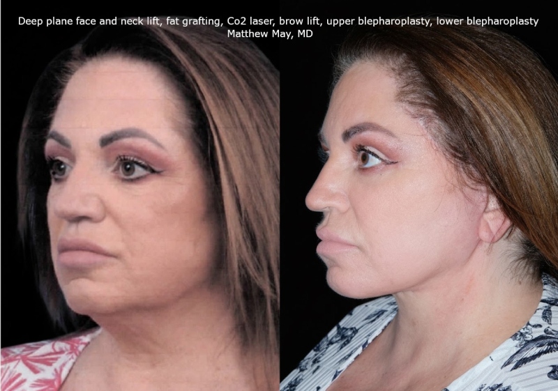 Rhinoplasty Before & After Image