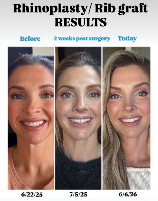 Rhinoplasty Before & After Image
