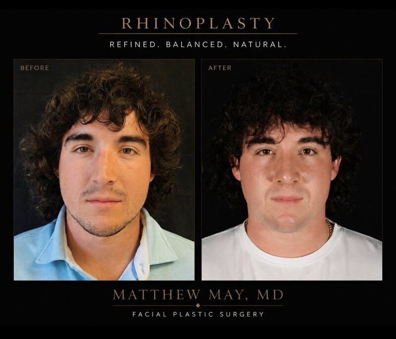Rhinoplasty Before & After Image
