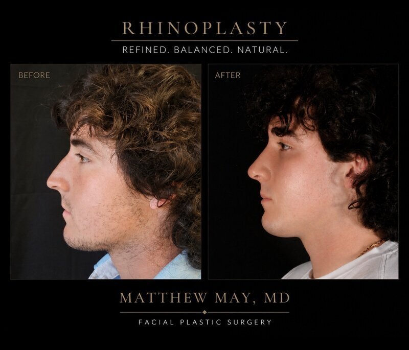 Rhinoplasty Before & After Image