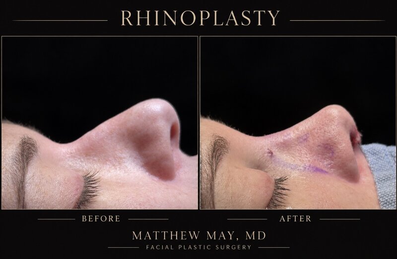 Rhinoplasty Before & After Image