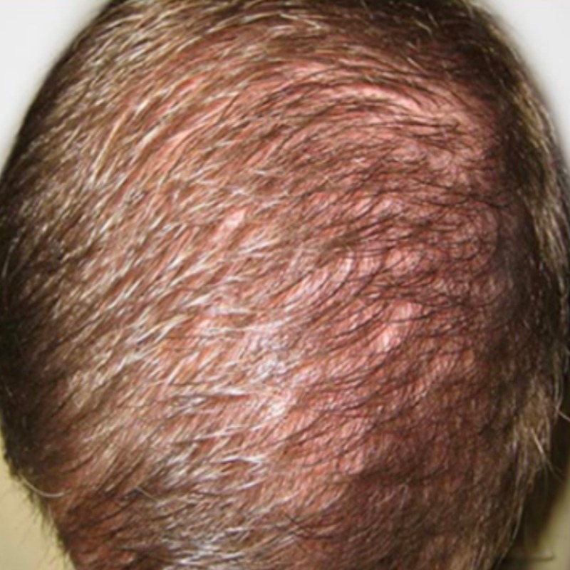 GetHairMD Before & After Image
