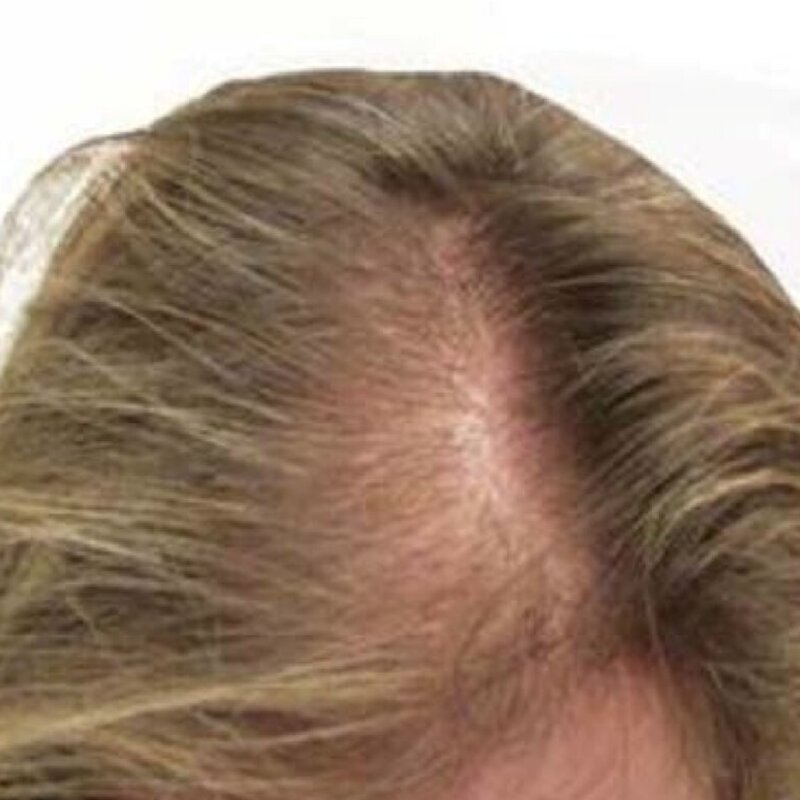 gethairmd Before & After Image