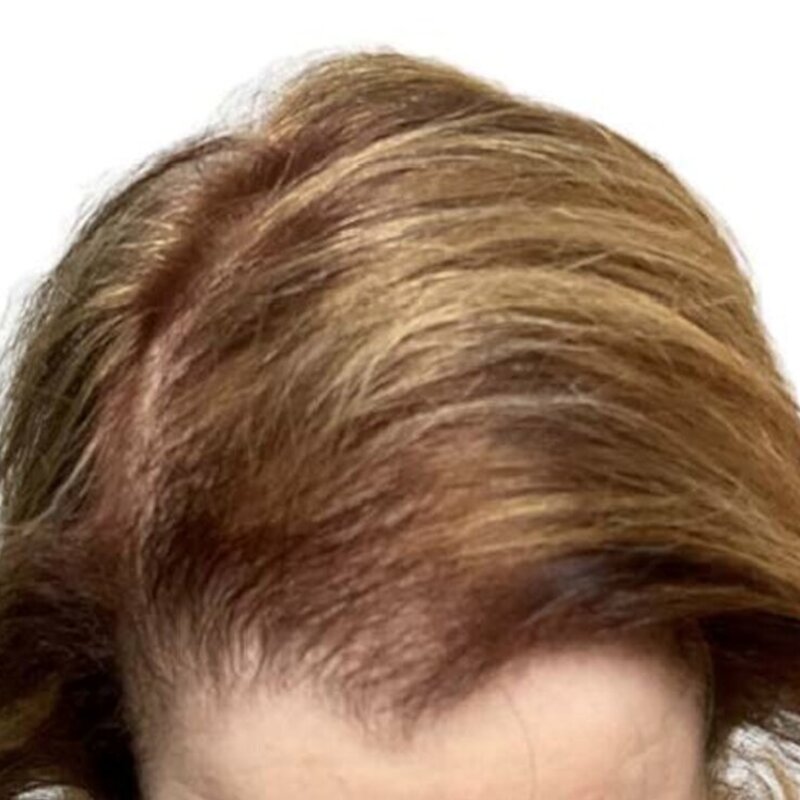 gethairmd Before & After Image