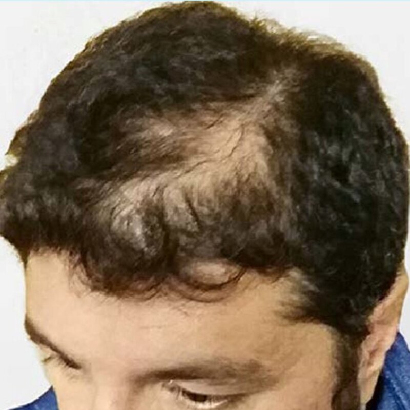 GetHairMD Before & After Image