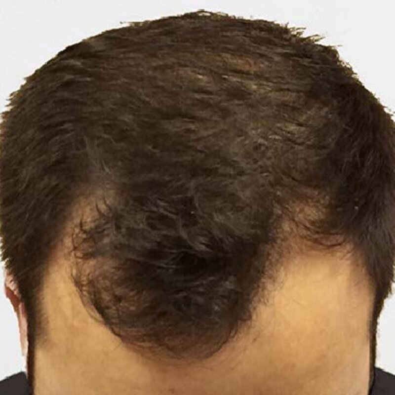 GetHairMD Before & After Image