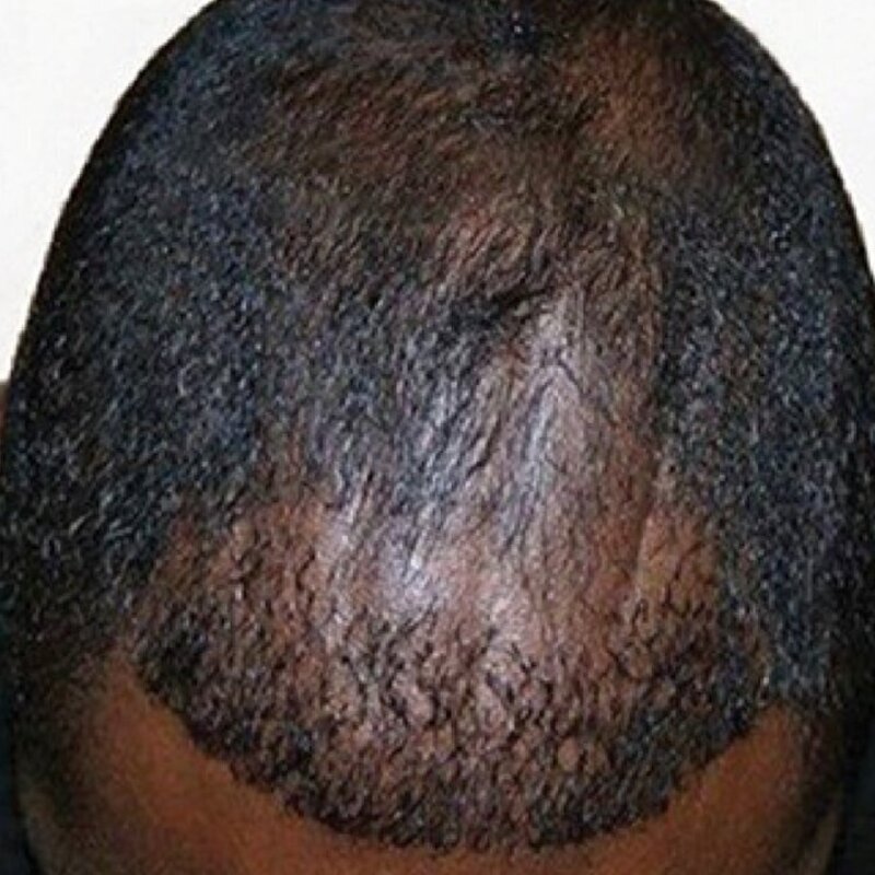 GetHairMD Before & After Image