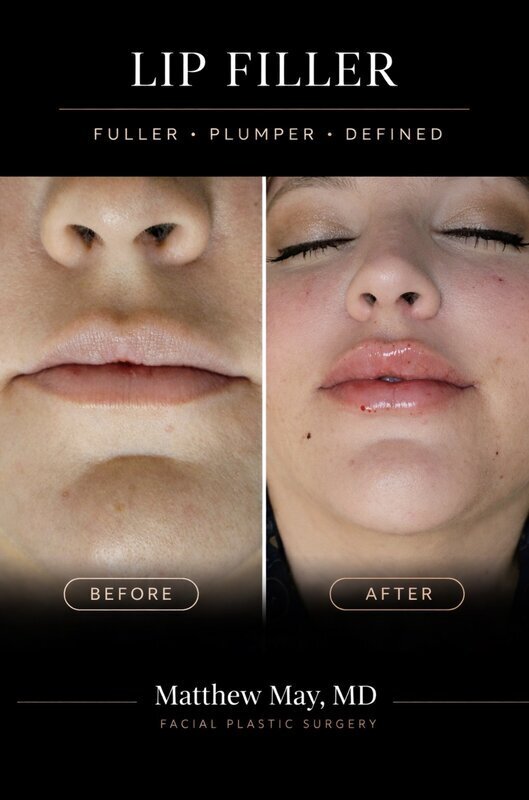 Lip Filler Before & After Image