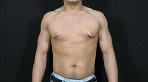 Gynecomastia Before & After Image