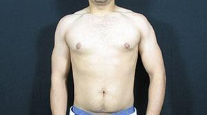 Gynecomastia Before & After Image