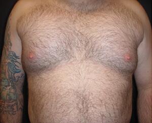 Pectoral Implants Before & After Image