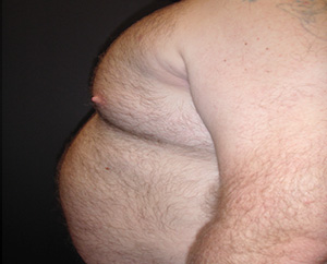 Pectoral Implants Before & After Image