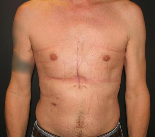 Pectoral Implants Before & After Image