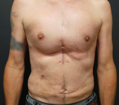 Pectoral Implants Before & After Image